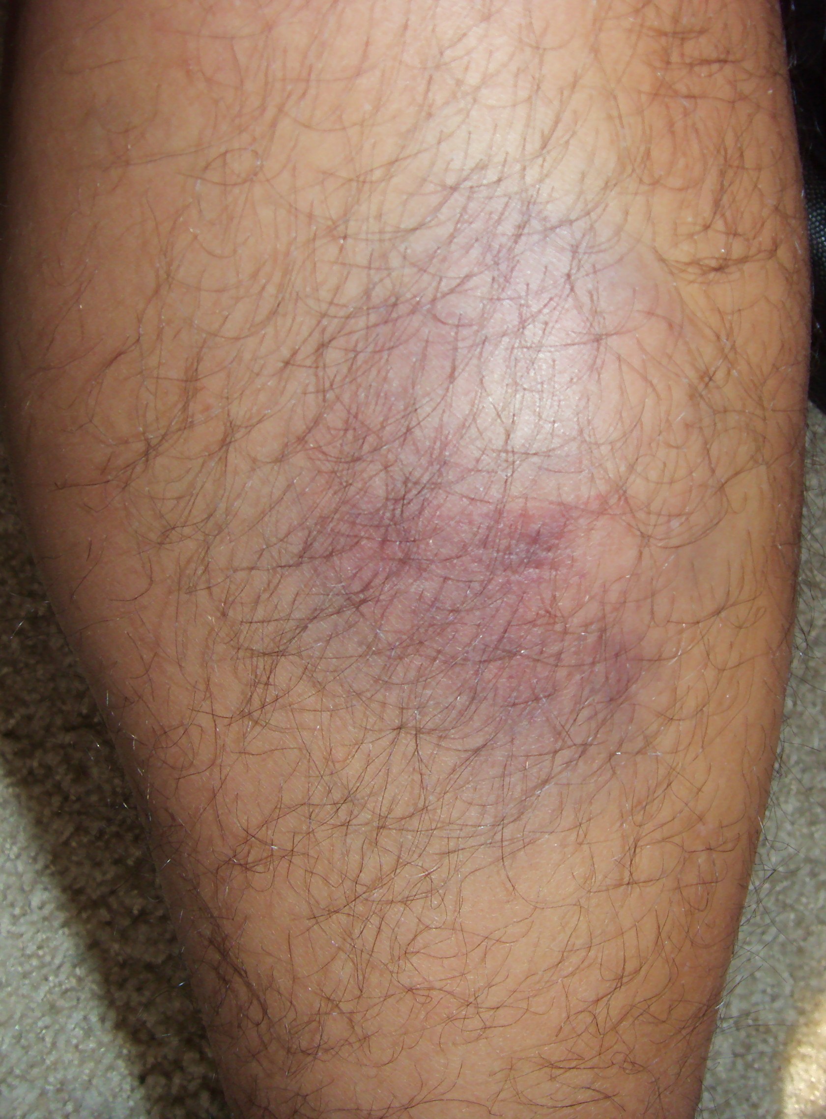 legbruise1